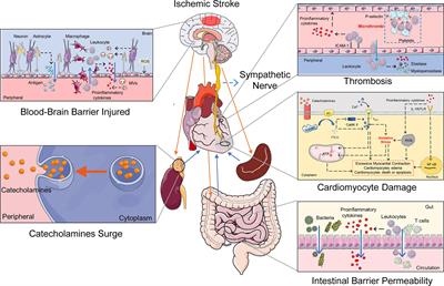 Cerebral-Cardiac Syndrome and Diabetes: Cardiac Damage After Ischemic Stroke in Diabetic State